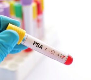 PSA test